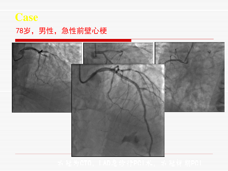 冠心病讲义.ppt_第3页