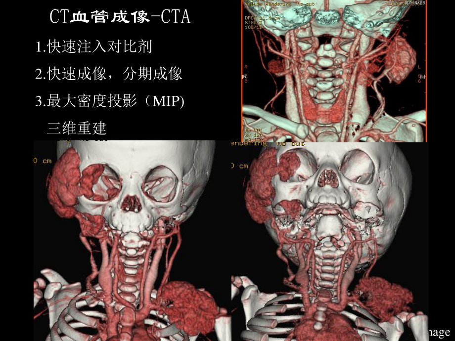 CTMR在儿科的应用-孙国强.ppt_第3页