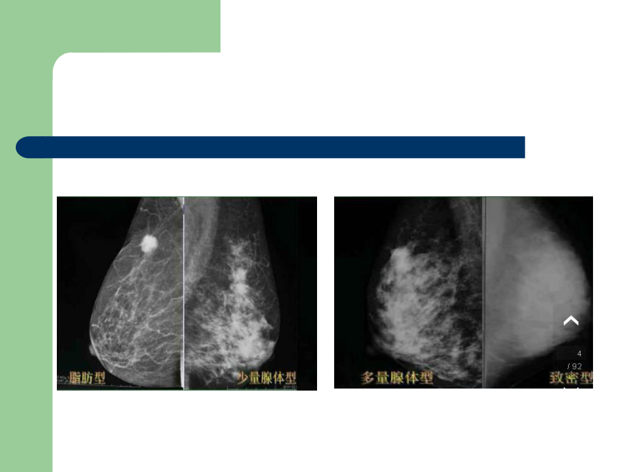 乳腺BIRADS分级.ppt_第3页