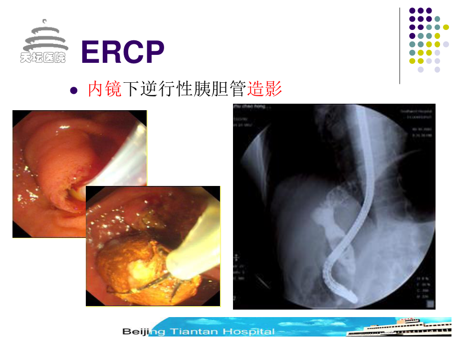 内镜下逆行性胰胆管造影.ppt_第3页