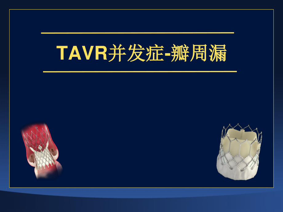 TAVR并发症-瓣周漏.ppt_第1页