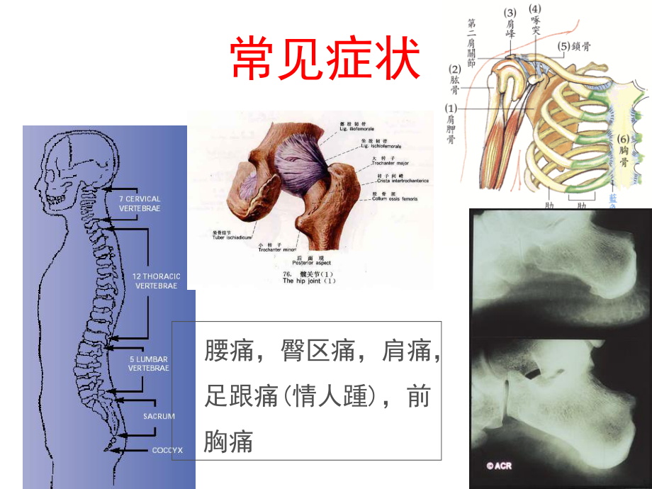 AS髋关节受累的思考.ppt_第3页