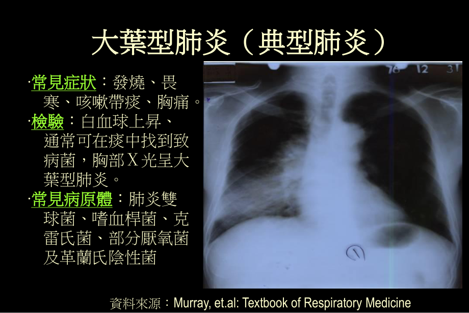 严重急性呼吸道症候群.ppt_第2页