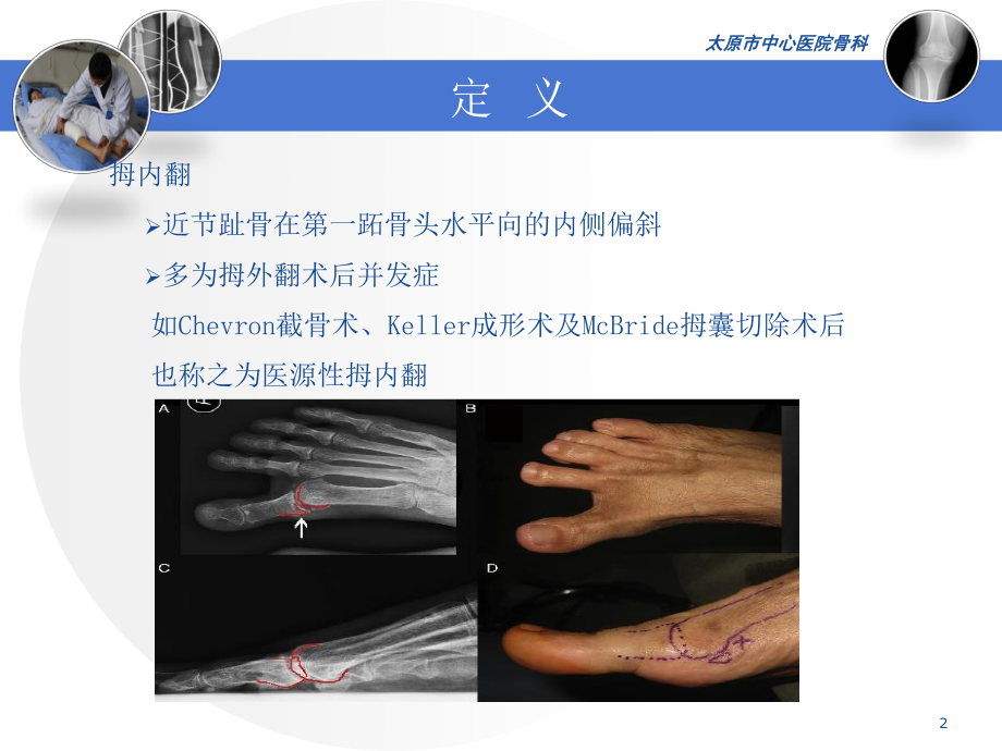 医源性拇内翻2015.11.1--杜虎羽.ppt_第2页