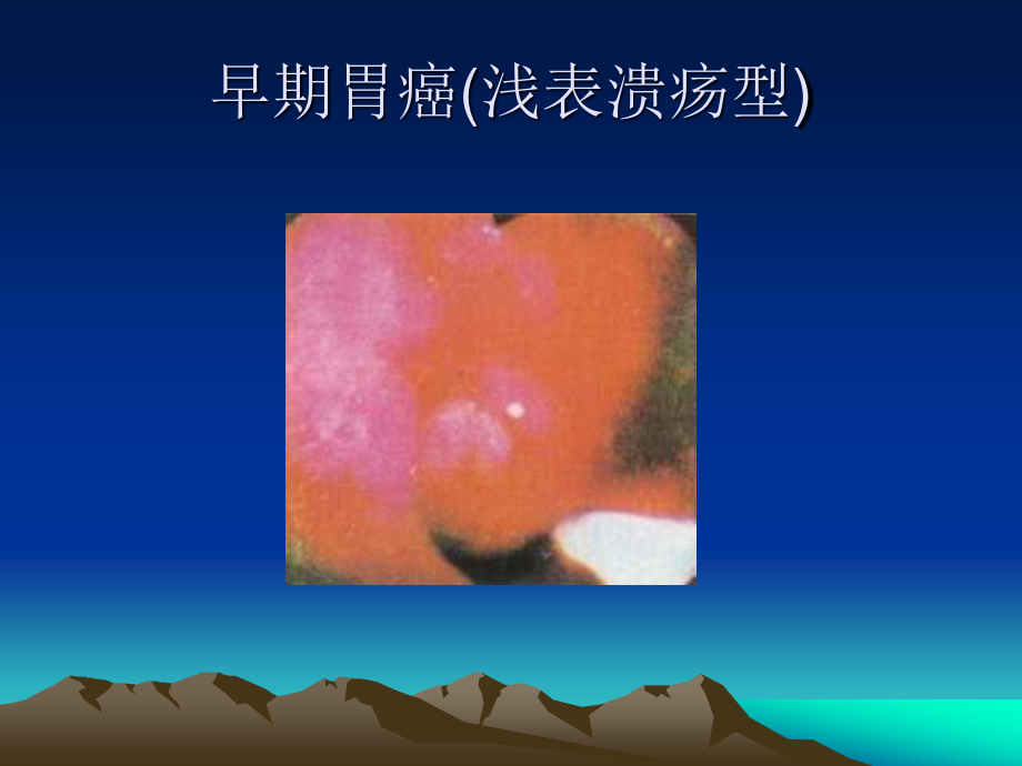 什么是胃癌？..ppt_第3页