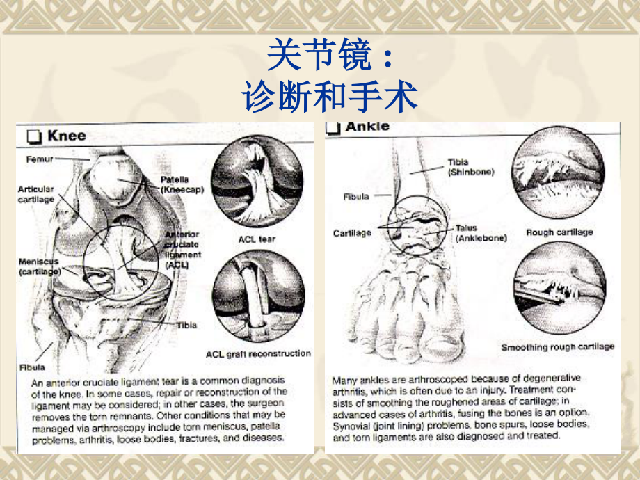 关节镜手术.ppt_第3页