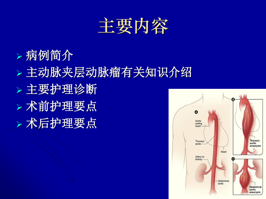 主动脉夹层动脉瘤围手术期教学查房.ppt_第2页