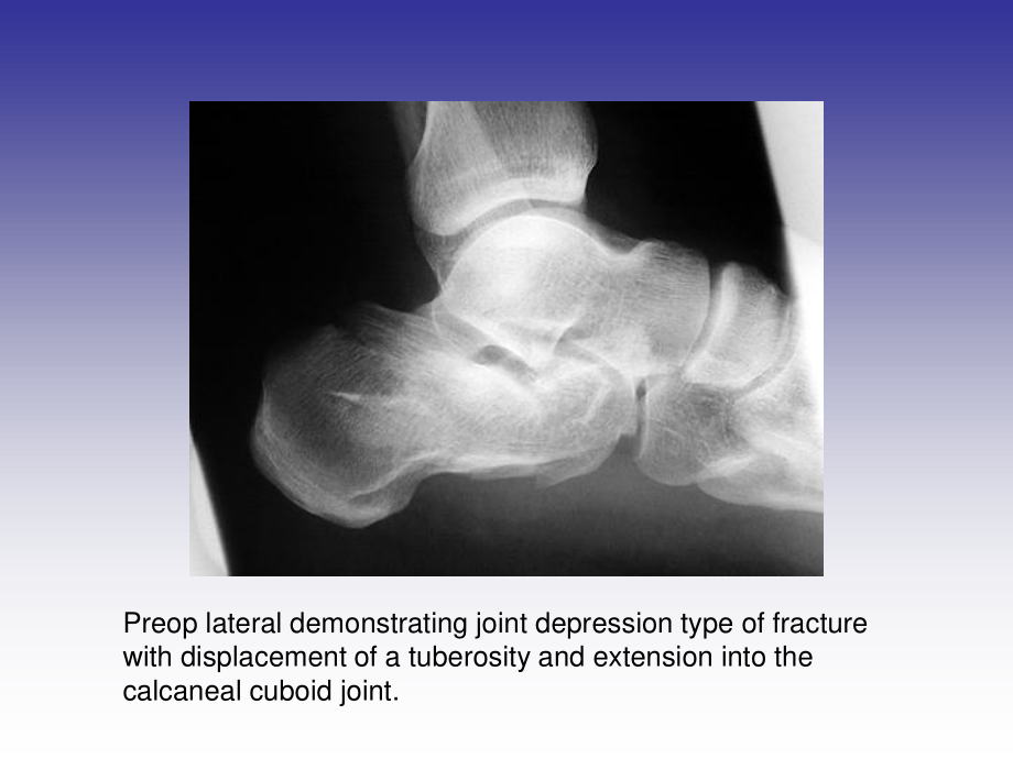 CALCANEU跟骨骨折.ppt_第2页