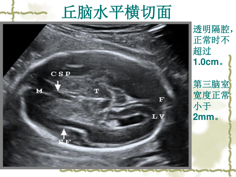 中孕期胎儿超声检查标准切面.ppt_第3页