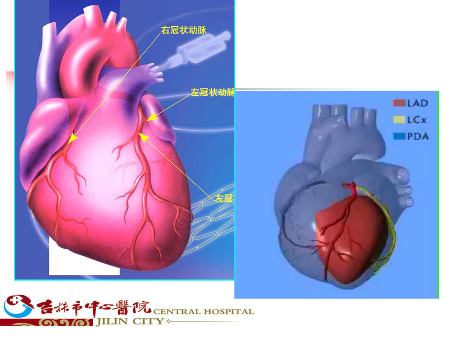 冠心病科普.ppt_第3页