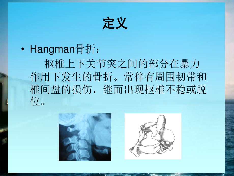 Hangman骨折.ppt_第2页