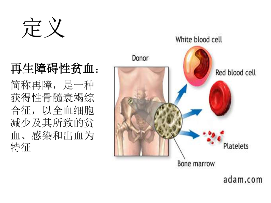 再生障碍性贫血(七年制).ppt_第2页