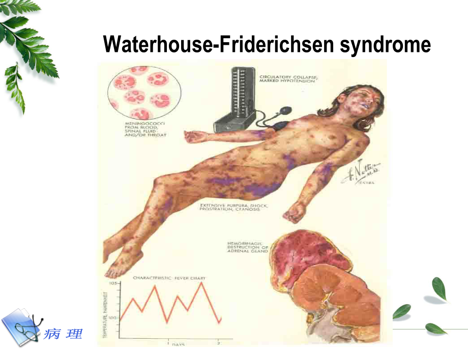 凝血和抗凝血平衡紊乱.ppt_第3页