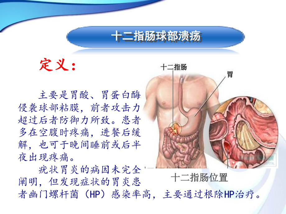 十二指肠球部溃疡.ppt_第2页