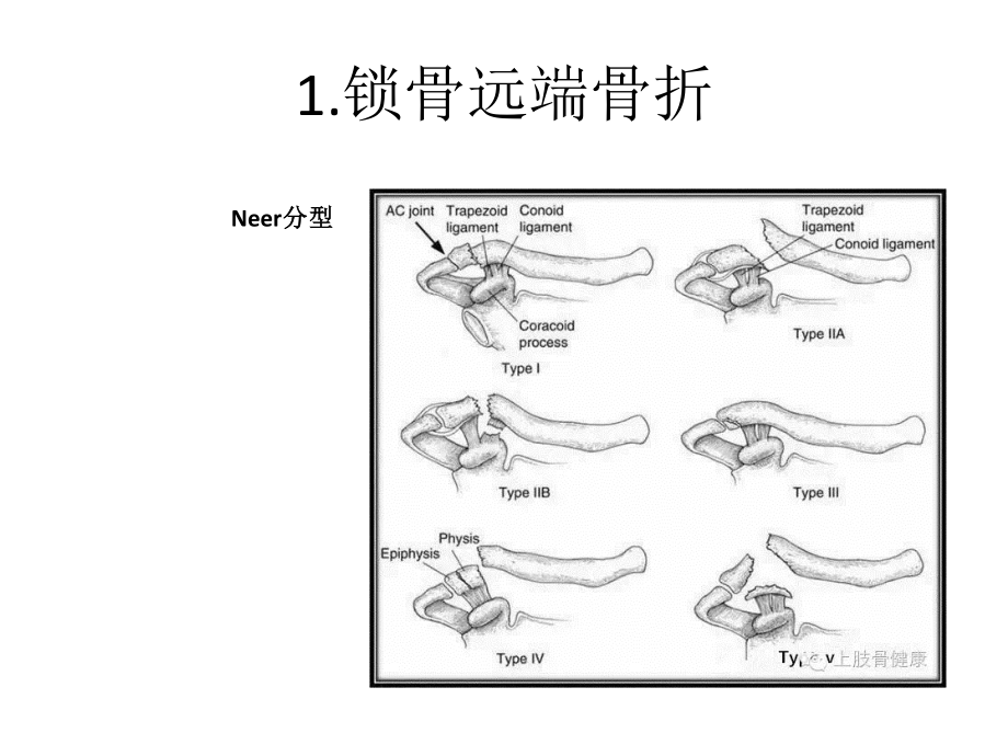 上肢骨折分型.pptx_第2页