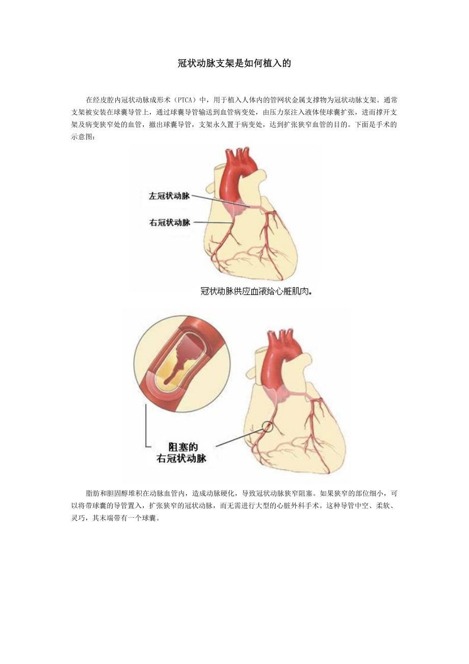 冠状动脉支架是如何植入的.doc_第1页