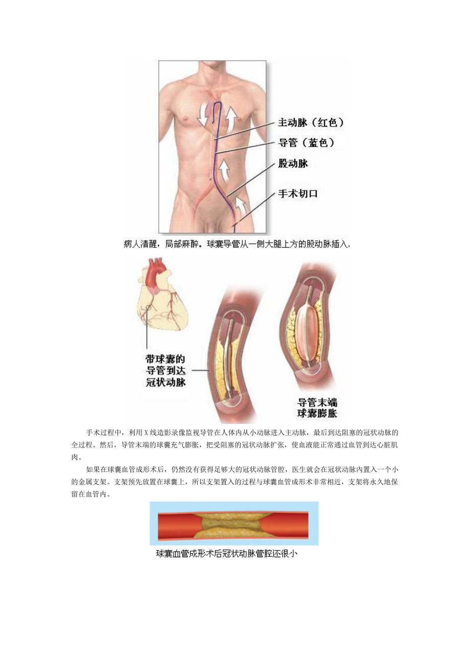 冠状动脉支架是如何植入的.doc_第2页