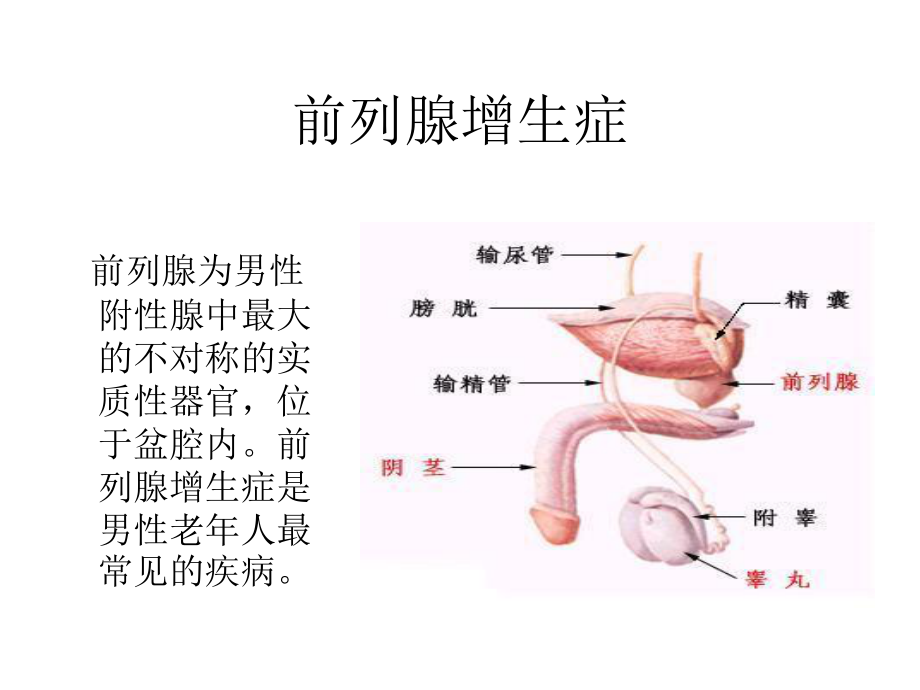 前列腺增生症.ppt_第1页