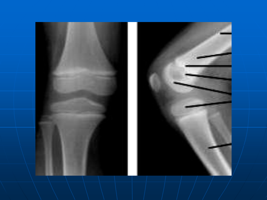 儿童骨关节损伤.ppt_第3页