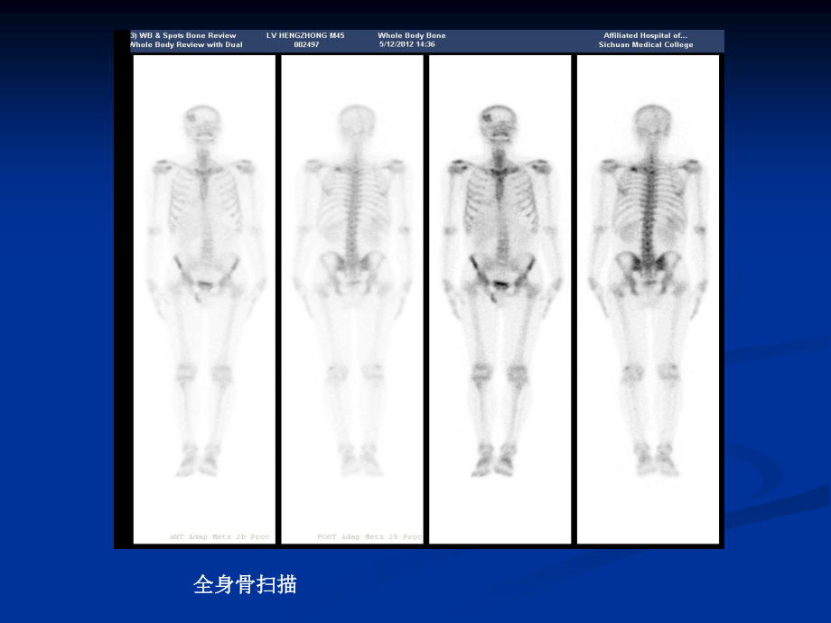 99mTc-MDP骨显像骨外异常显影.ppt_第3页