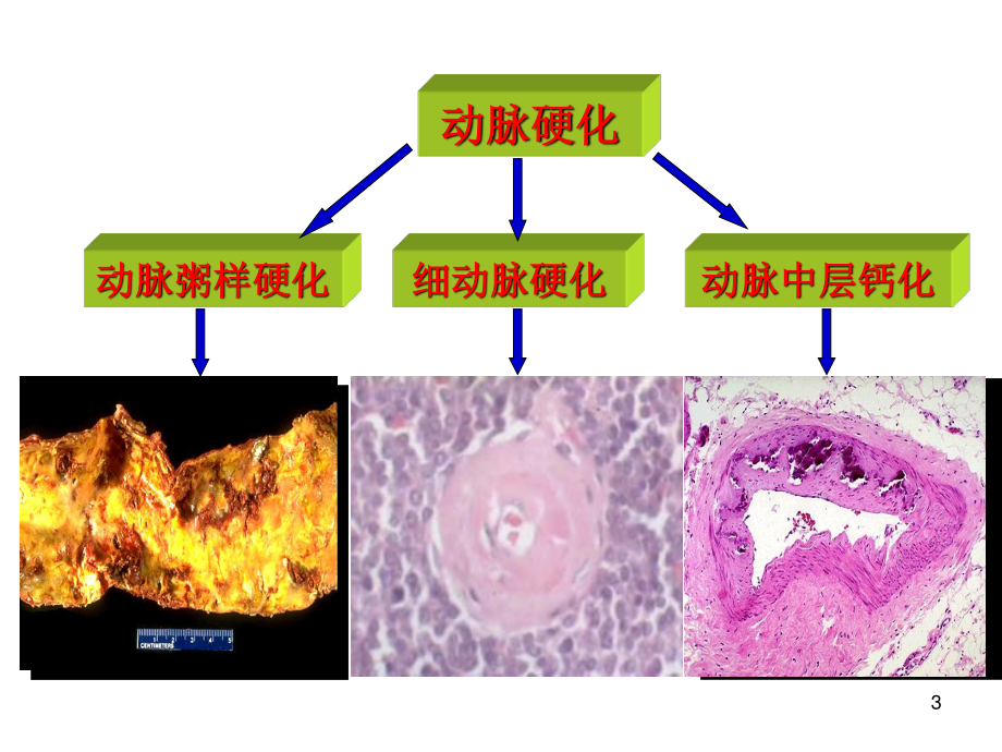 动脉粥样硬化.ppt_第3页