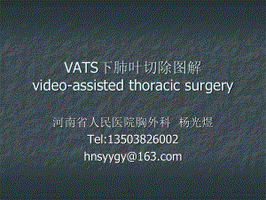 VATS肺叶切除.ppt