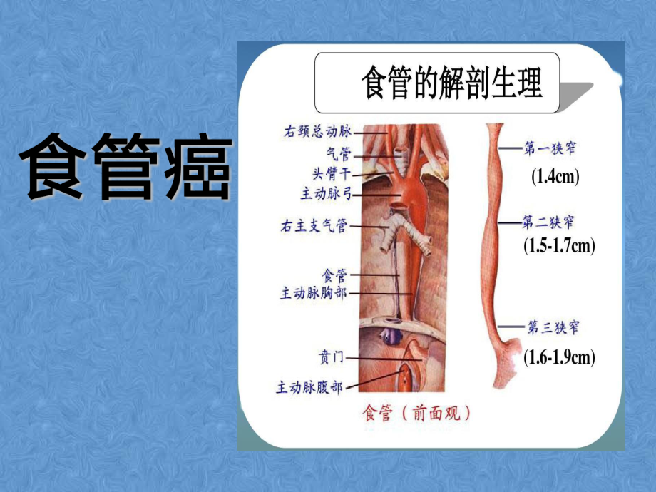 F4食管癌病例讨论.ppt_第2页