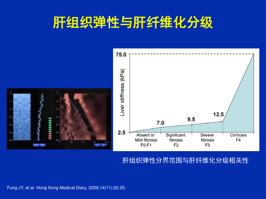 乙肝肝硬化并发症的处理.ppt_第3页