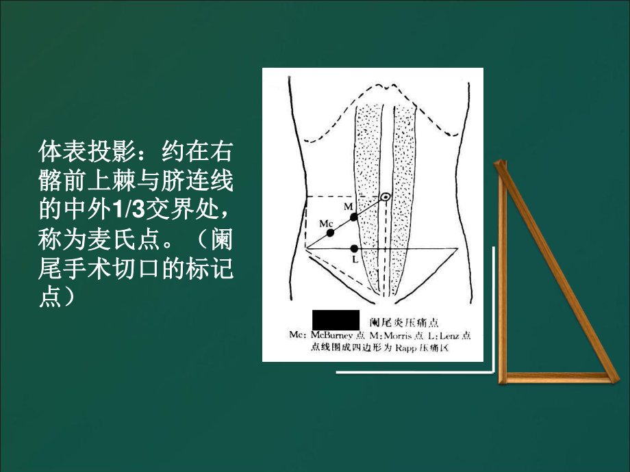 不可轻视的小病阑尾炎.ppt_第3页