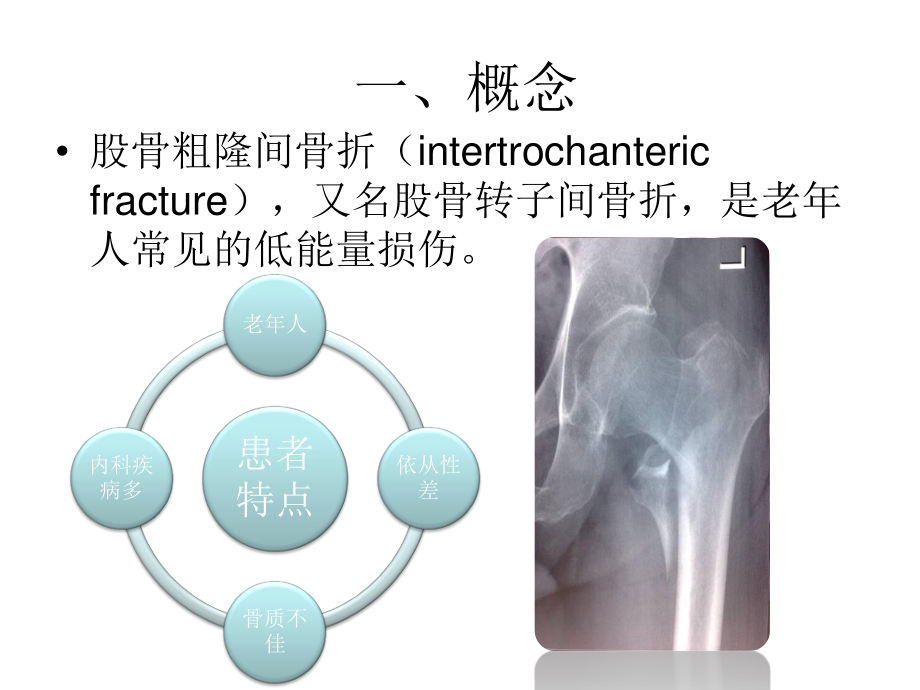 PFNA在股骨粗隆间骨折的应用.ppt_第3页