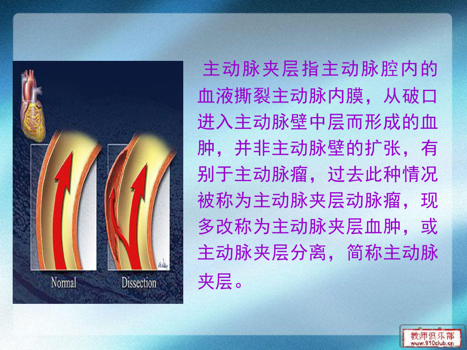 主动脉夹层的诊治.ppt_第2页