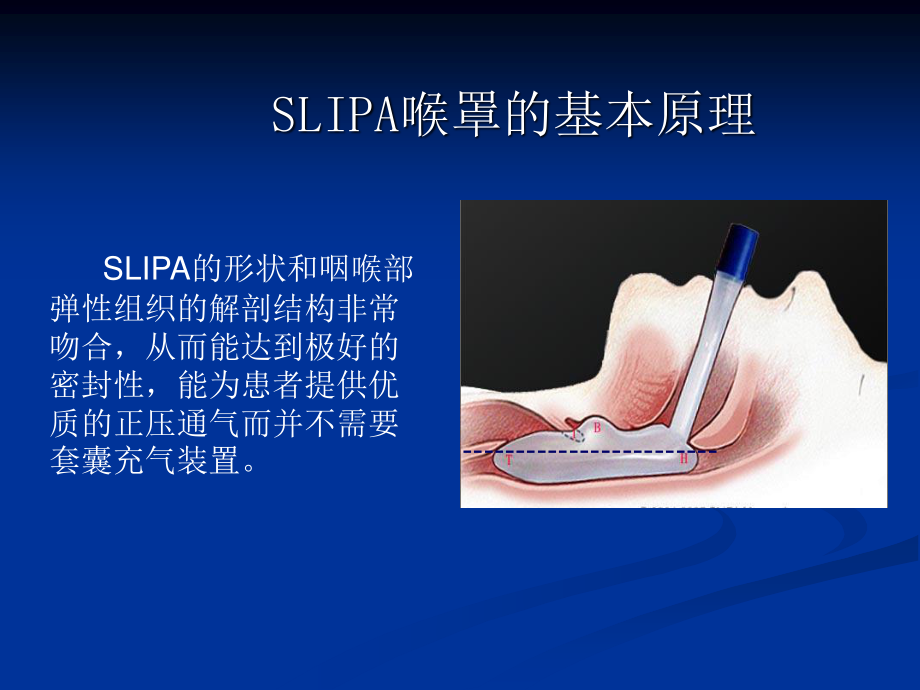 SLIPA免充气喉罩.ppt_第3页