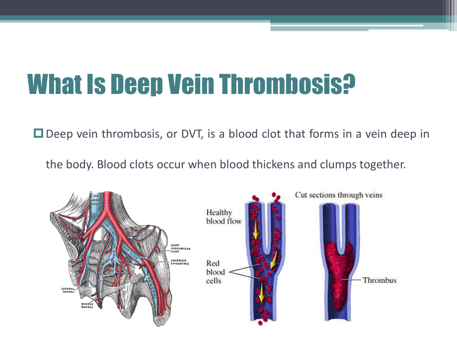 Deep-vein-thrombosis深静脉血栓.ppt_第3页