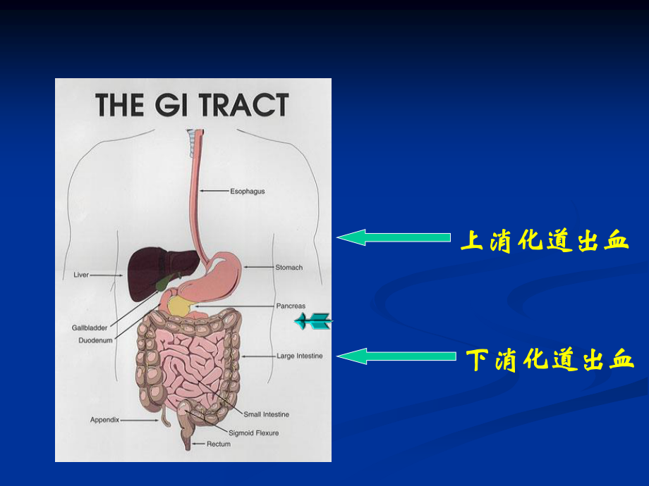 上消化道出血--刘茗.ppt_第3页