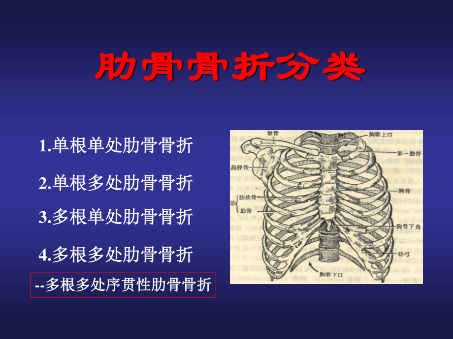 创伤性连枷胸合并ARDS.ppt_第3页