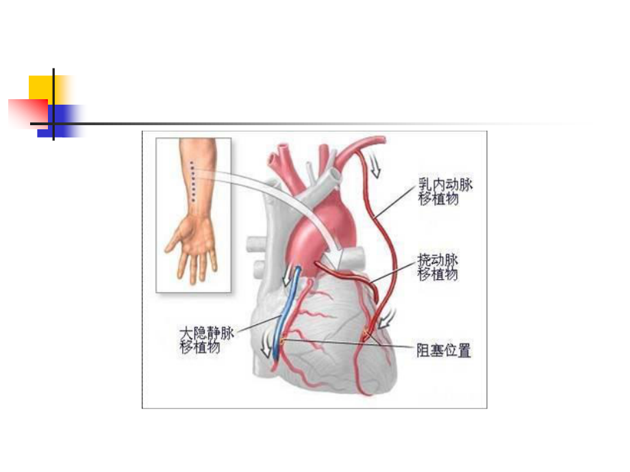 冠脉搭桥术健康宣教.ppt_第3页