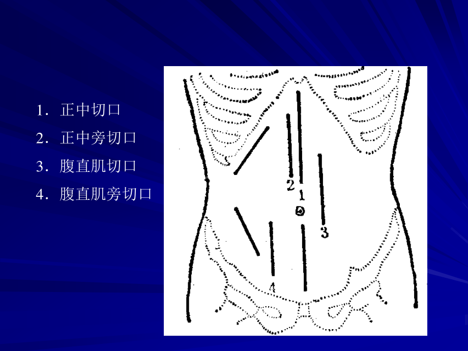 6常用腹部切口及显露法.ppt_第2页