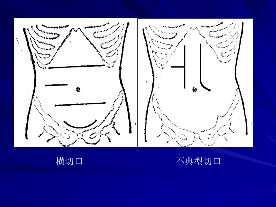 6常用腹部切口及显露法.ppt_第3页