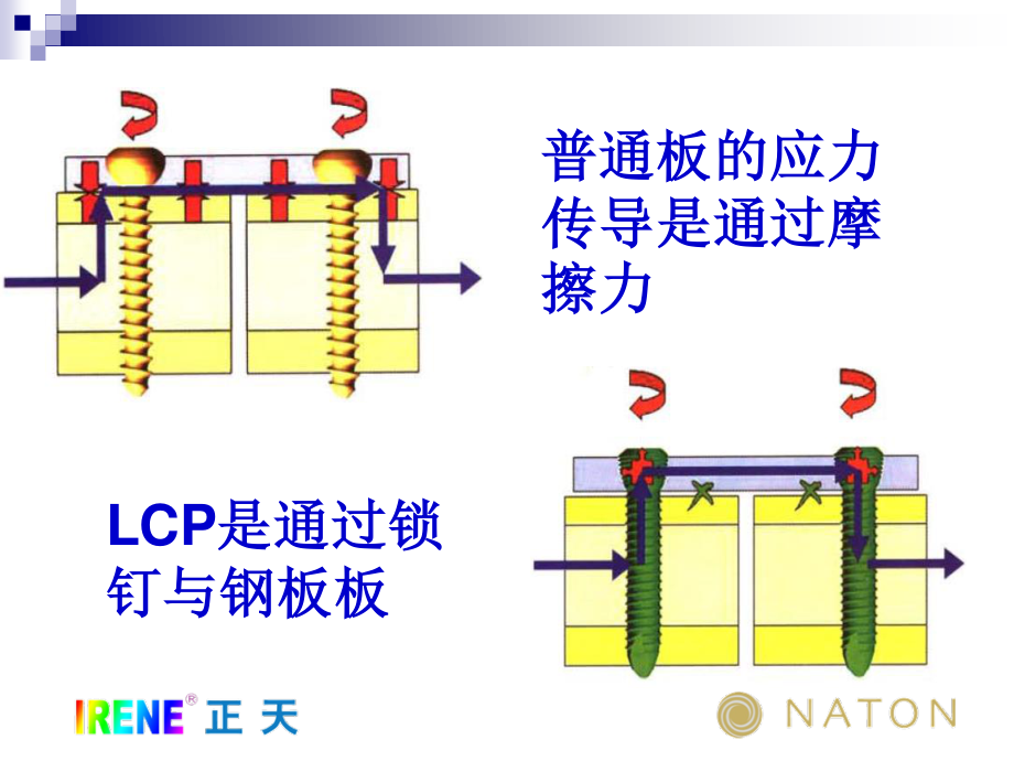 LCP系统接骨板的注意问题及常见问题(免金币).ppt_第3页