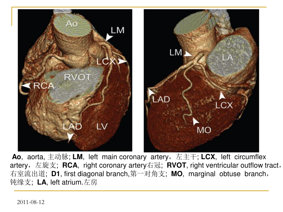 冠状动脉CTA图像判读.ppt_第2页