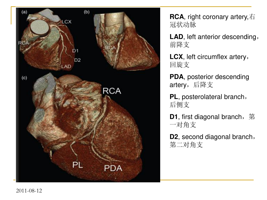 冠状动脉CTA图像判读.ppt_第3页