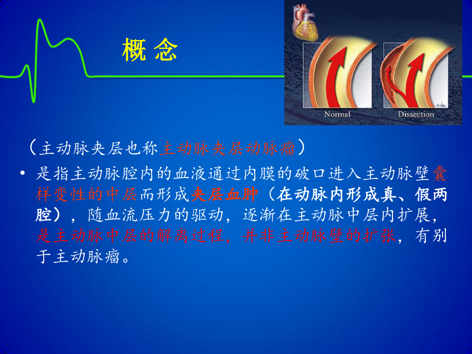 主动脉夹层(修改版).ppt_第3页