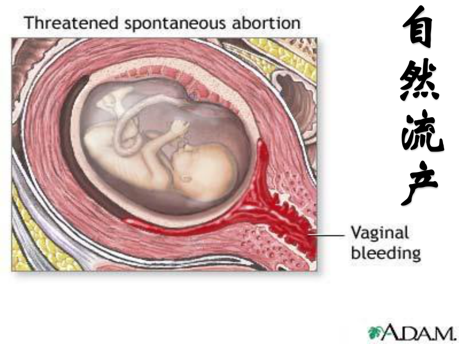 不全流产.ppt_第3页