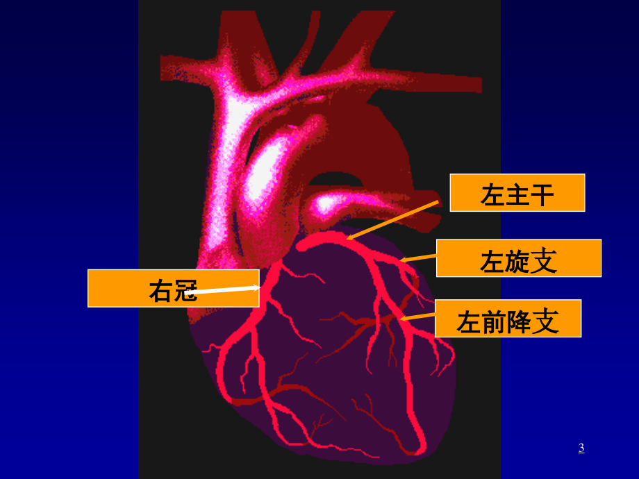 冠心病教学要PPT.ppt_第3页