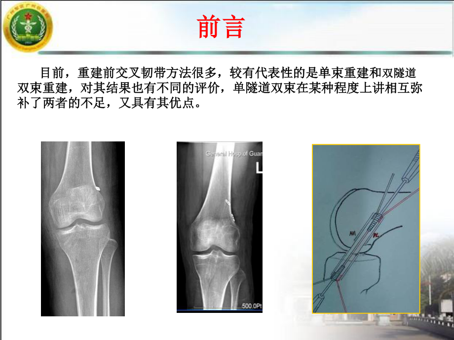 单隧道双束前交叉韧带重建的中期疗效观察.ppt_第2页