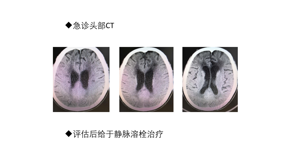 关于静脉溶栓后发生早期神经功能恶化原因探讨.ppt_第3页