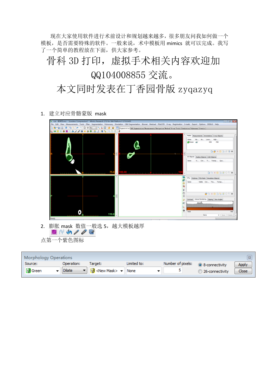 mimics手术导板制作-简单易行.docx_第1页