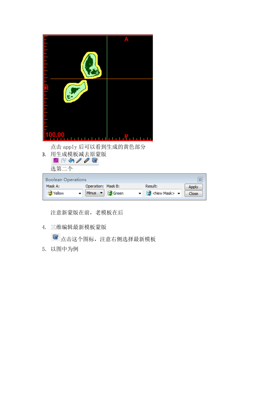 mimics手术导板制作-简单易行.docx_第2页