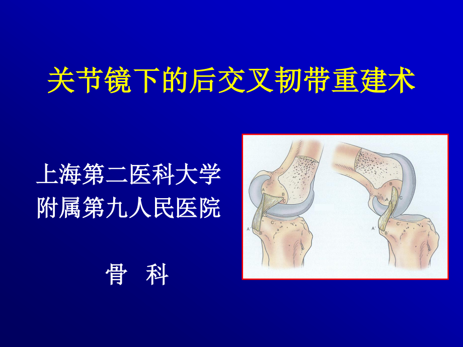 关节镜下的后交叉韧带重建术.ppt_第1页