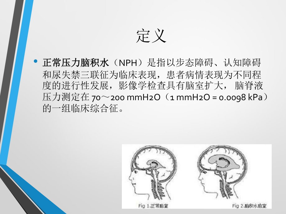 中国特发性正常压力脑积水诊治专家共识(2016).ppt_第2页